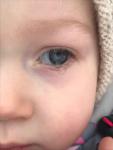 Слезотечение и нагноение глаза у ребёнка 1.5г фото 1
