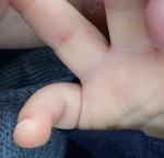 Что такое у ребенка на пальчике? фото 1