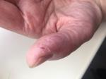 Трещины на большом пальце руки фото 1