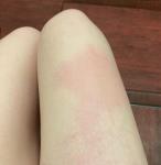 Аллергическая реакция на ногах фото 3