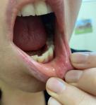 Проблемы слизистой рта фото 4