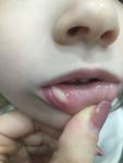 Язва внутри нижней губы у ребенка 3 лет фото 1