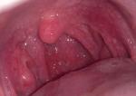 Сыпь в горле при коронавирусе фото 1