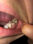 Трещина зуба, гранулема фото 2