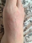 Аллергия на ступнях фото 1
