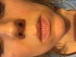 Покраснение лица на щеках и вокруг рта фото 1