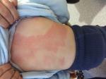 Аллергия в течении недели на геделикс фото 2