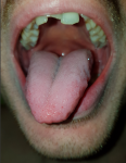 Белый налеи и отпечатки зубов на языке фото 1