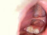 Белое пятно на зубе у ребёнка фото 2