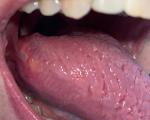 Новообразование полости рта с дисплазией, рецидив фото 1
