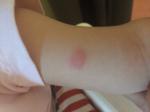 Красные выпуклые пятна на теле ребенка с одной стороны фото 1