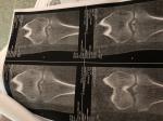 Травма коленного сустава, перелом межмыщелкового возвышения фото 1