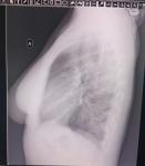 Рентген легких, подскажите пожалуйста была ли пневмония или нет фото 2