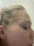 Ужасные гнойные воспаления на лице и волосистостей части головы фото 4