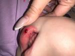 Ребёнок разбил губу образовалась гематома кровяная сверху фото 1