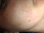 Аллергия или инфекция? фото 1