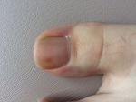 Коричневое пятно под ногтем большого пальца ноги фото 2