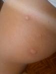 Сыпь в виде укусов комаров фото 1