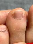 Продольная темная полоса на ногте-подногтевая меланома? фото 2
