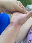 Сыпь у ребёнка на руке фото 1