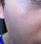 Красное пятно на лице, не проходит три месяца! фото 1