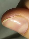Отслоение и воспаление кожи вокруг ногтей несколько месяцев фото 3