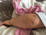 Сыпь у ребёнка на руках и ногах фото 2