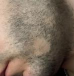Выпадение волос по всему телу и на бороде фото 3