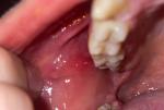Красное горло и воспаление слизистой фото 2