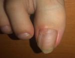 Нарост на ногте ноги большого пальца фото 1