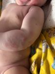 Атопический дерматит у ребёнка до года фото 1