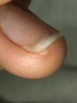 Отслоение и воспаление кожи вокруг ногтей несколько месяцев фото 4