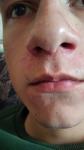 Себорейный дерматит на лице в районе носа у 18летнего парня фото 1