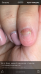 Дрожжевой грибок ногтя при ГВ фото 2