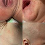 Высыпания на лице и груди у новорожденного фото 1