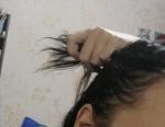 Выпадение волос на фоне аменореи фото 2