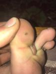 Чёрные точки на пальцах ног фото 2