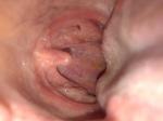 Воспаление горла, фарингит или рак фото 1