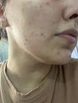 Сильные воспаленные высыпания на лице и верхней части туловища фото 3