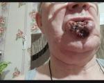 Рак нижней губы фото 1
