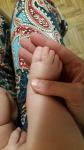 Синдактилия 2 и 3 пальцев у ребенка а ноге фото 2