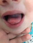 Стоматит на языке и щеках при насморке у ребёнка фото 1