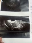 Трубная беременность фото 2