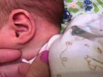 Сыпь за ушком у новорожденного фото 1
