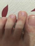 Красные пятна на на стопах и пальцах ног фото 2