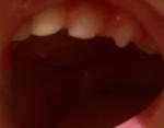 Желтый налет и клыки молочных зубов фото 2