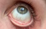 Пожелтение белков глаз и боли в правом подреберье фото 2