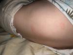 Красные пятна на спине ребенка фото 3