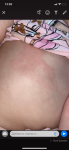 Аллергия или нет у ребенка фото 1