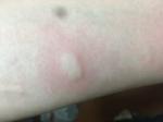 Прыщи похожие на укус комара фото 1